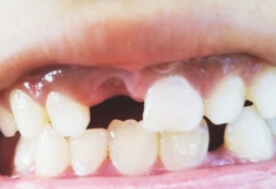 歯を失った場合の歯並びの変化写真