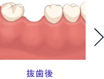 ①抜歯後の図